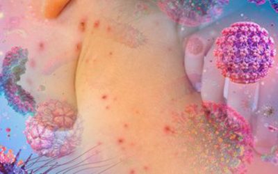 Preguntas y respuestas sobre la Viruela Simica